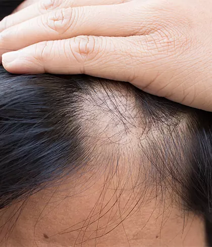 Alopecia sales areata stress